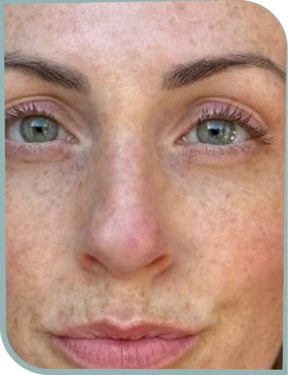 Pigment around nose, Before photo (result 10 of 10)