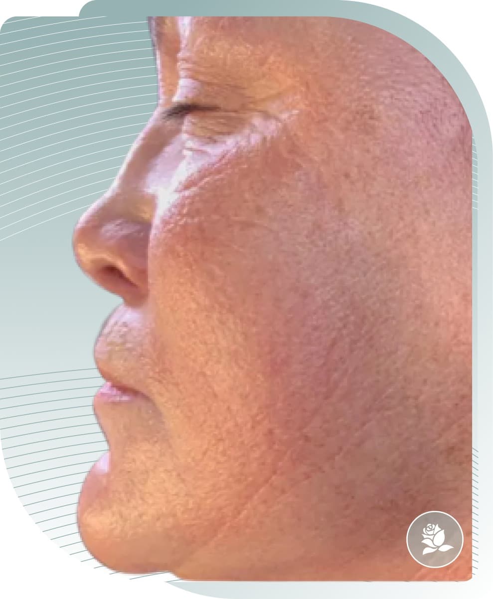 Skin Rejuvenation — After photo (result 3 of 5)