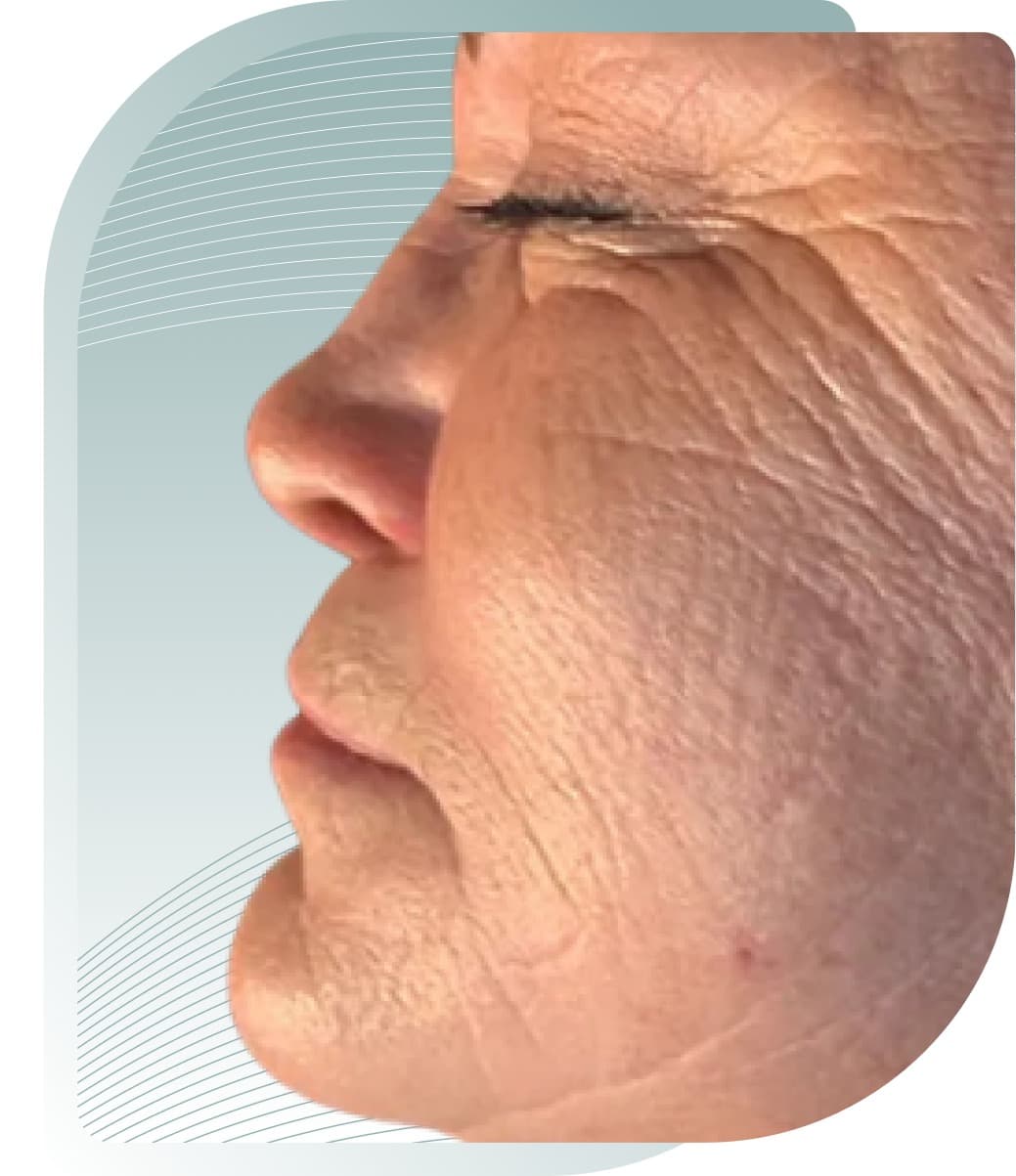 Skin Rejuvenation — Before photo (result 3 of 5)