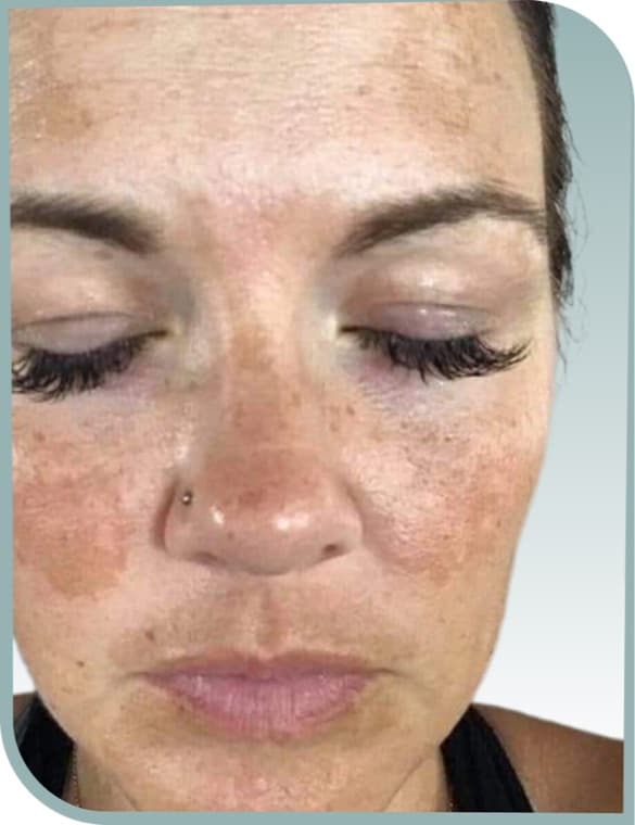 Melasma patches, Before photo (result 4 of 10)