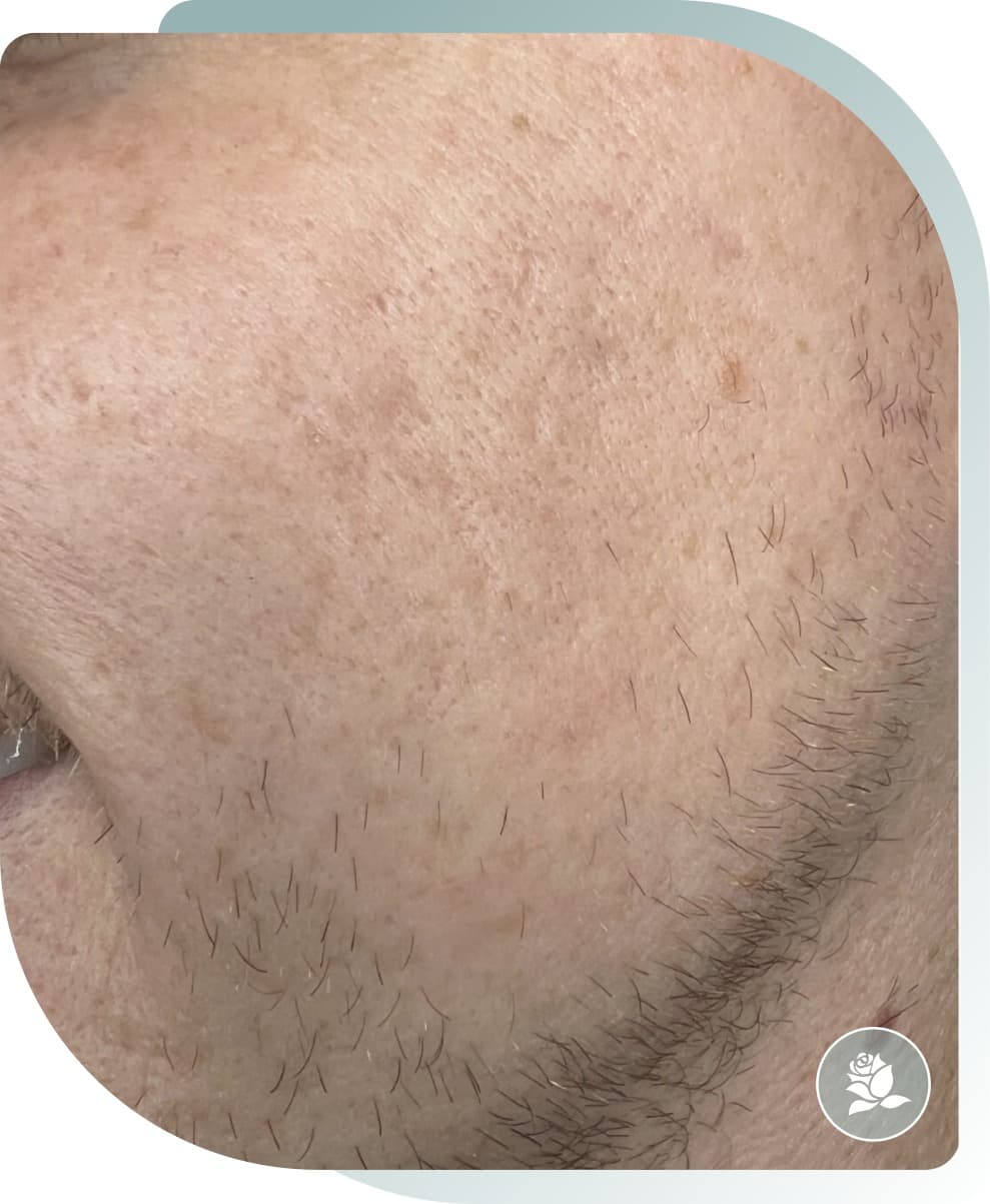Texture & Scarring — After photo (result 5 of 5)