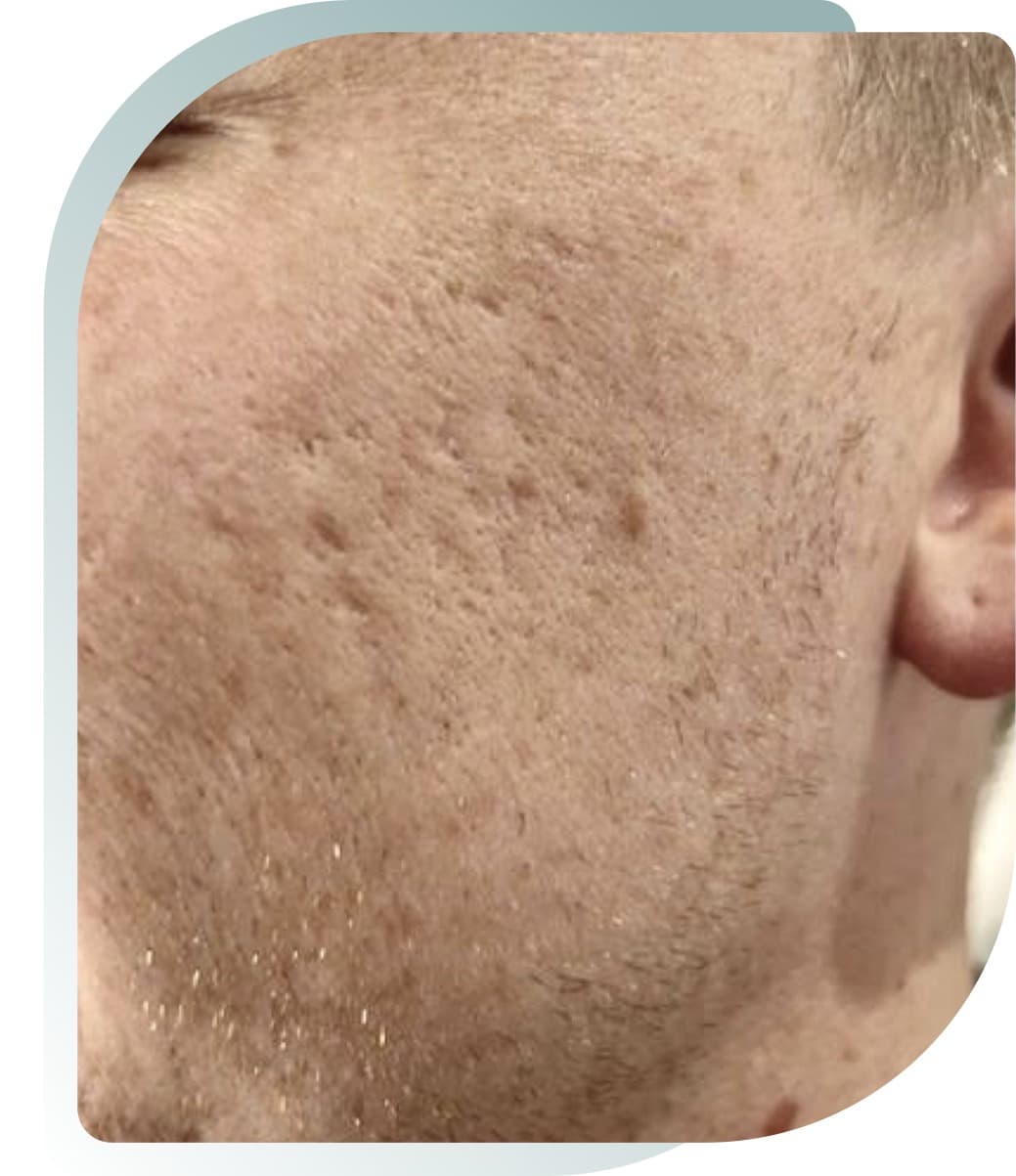 Texture & Scarring — Before photo (result 5 of 5)