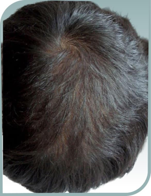 Crown hair loss, After photo (result 6 of 10)