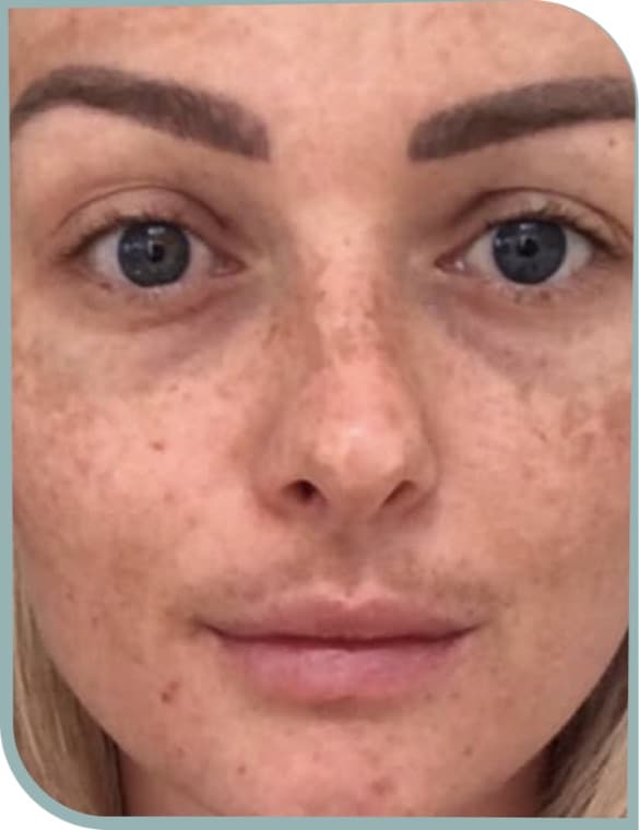 Under-eye shadows, Before photo (result 9 of 10)