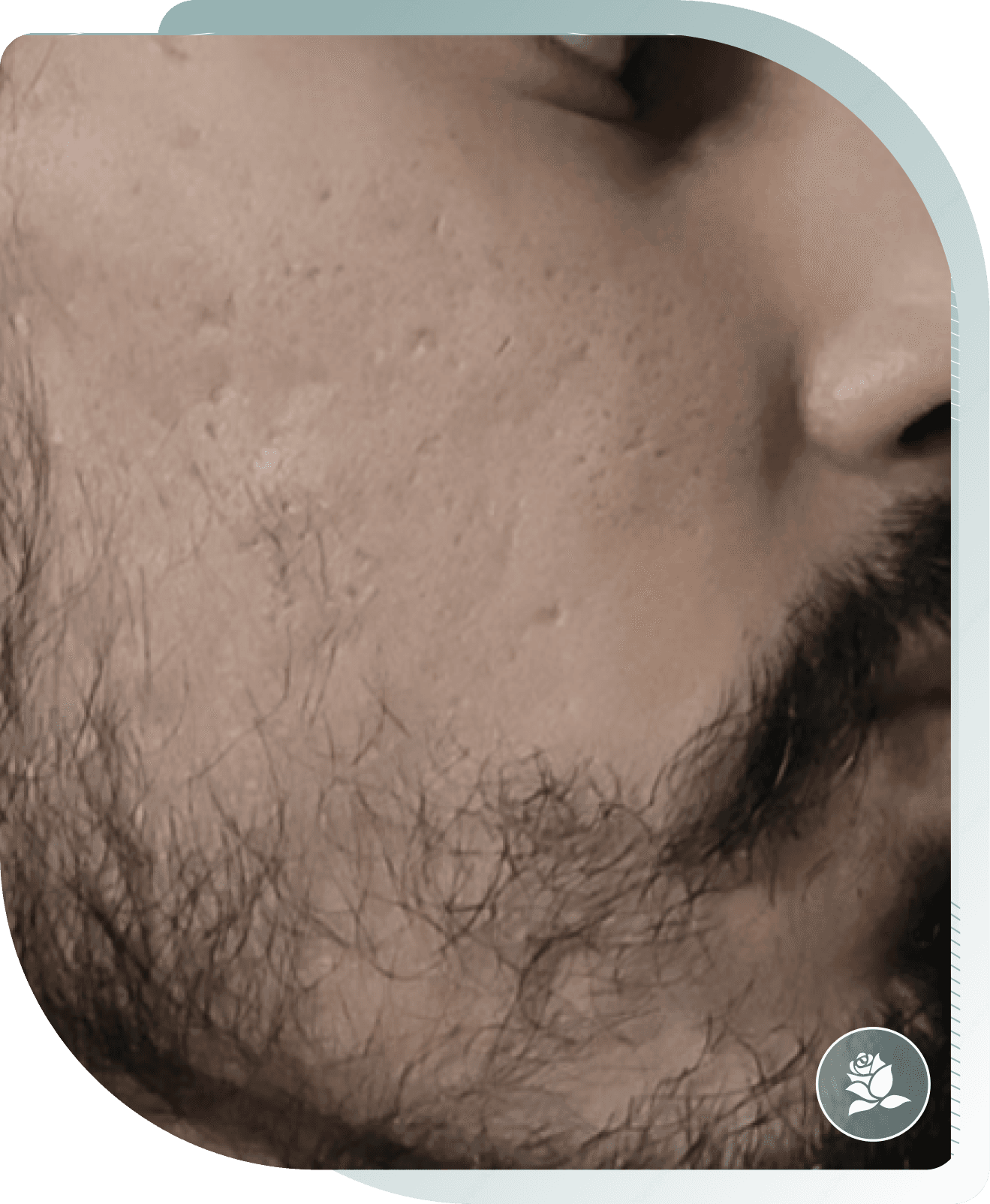 microneedling results — After photo (result 1 of 5)
