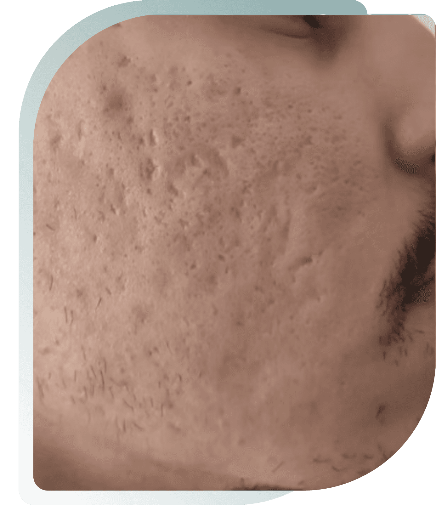 Before photo: Microneedling result at Carisma Aesthetics Malta