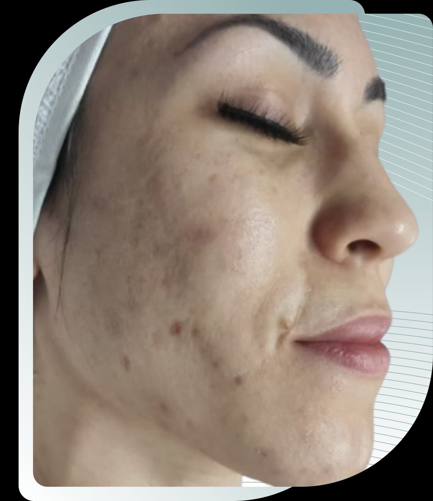 Exosome Glow Lift results — After photo (result 2 of 2)