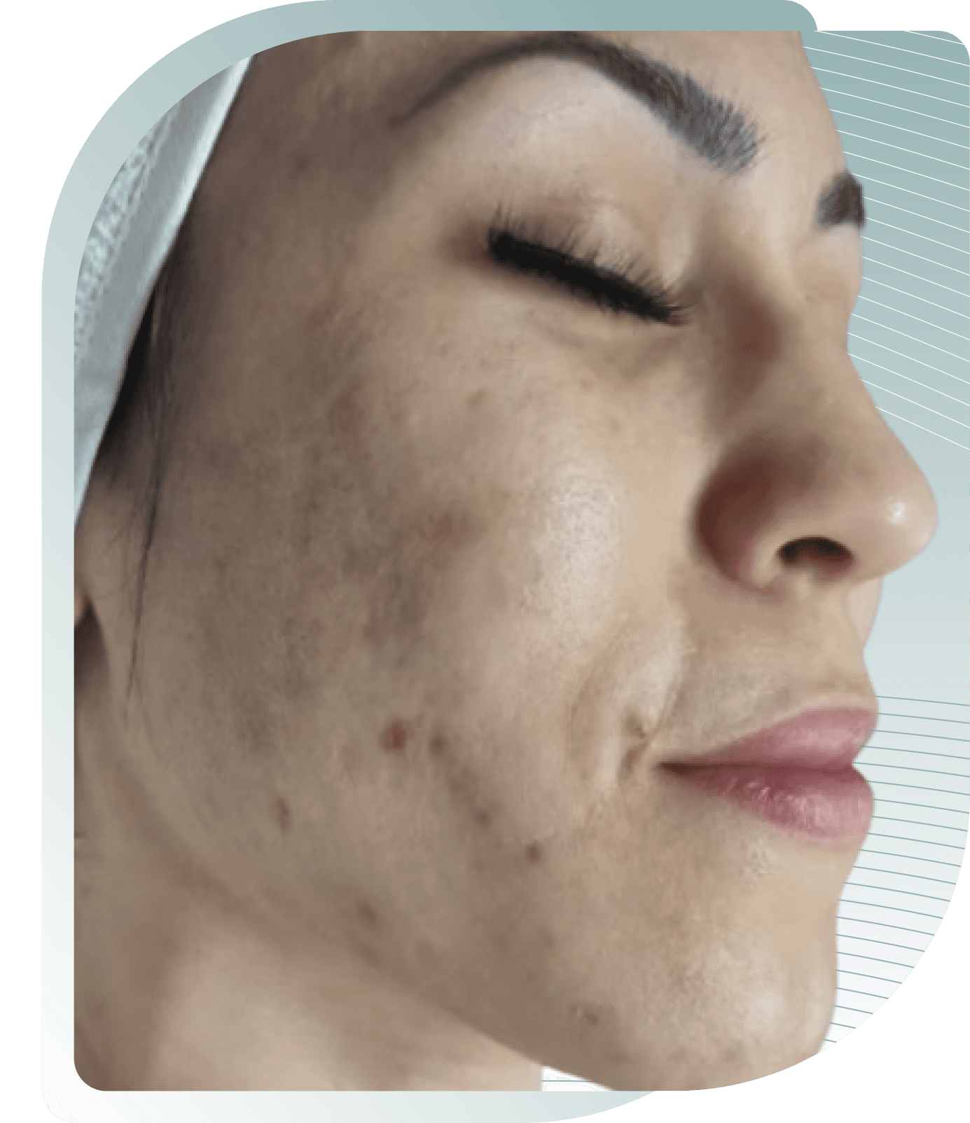 microneedling results — After photo (result 2 of 5)