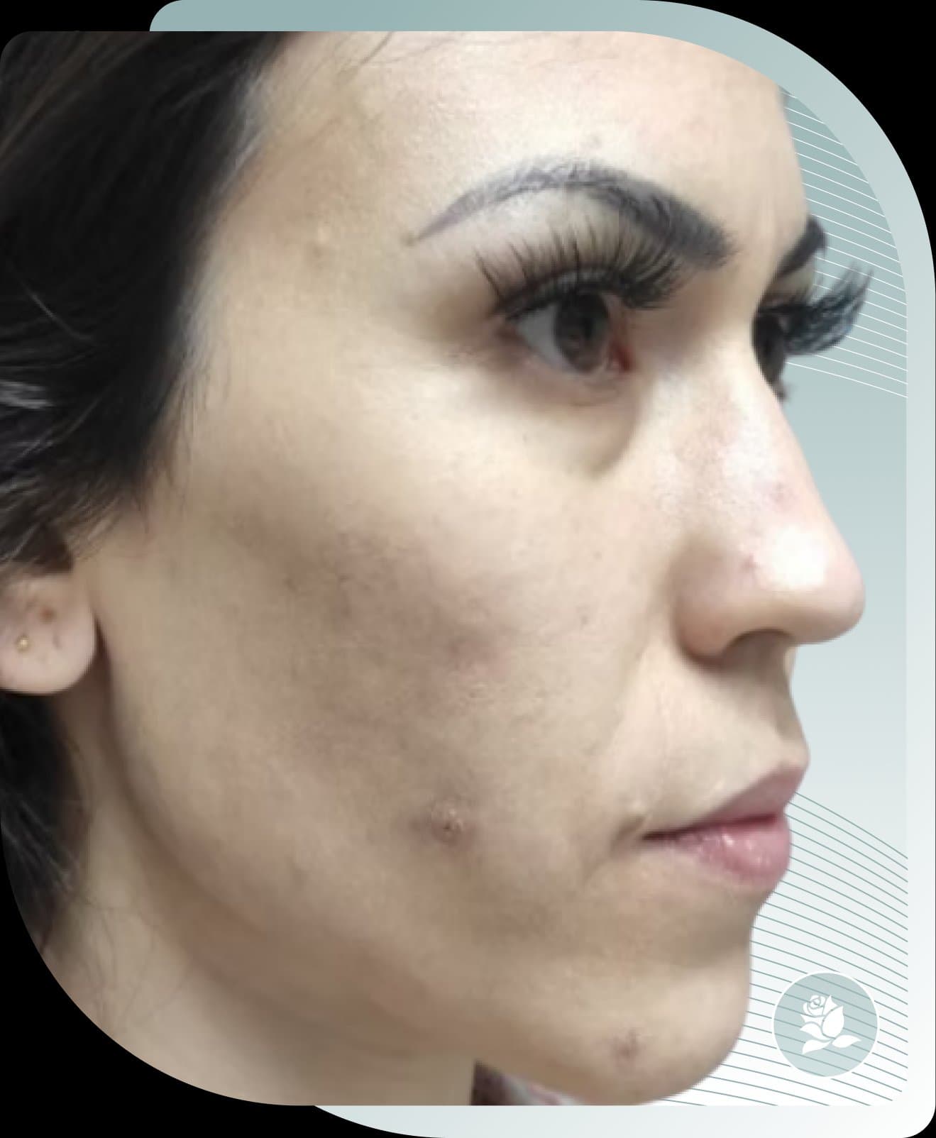 Exosome Glow Lift results — Before photo (result 2 of 2)