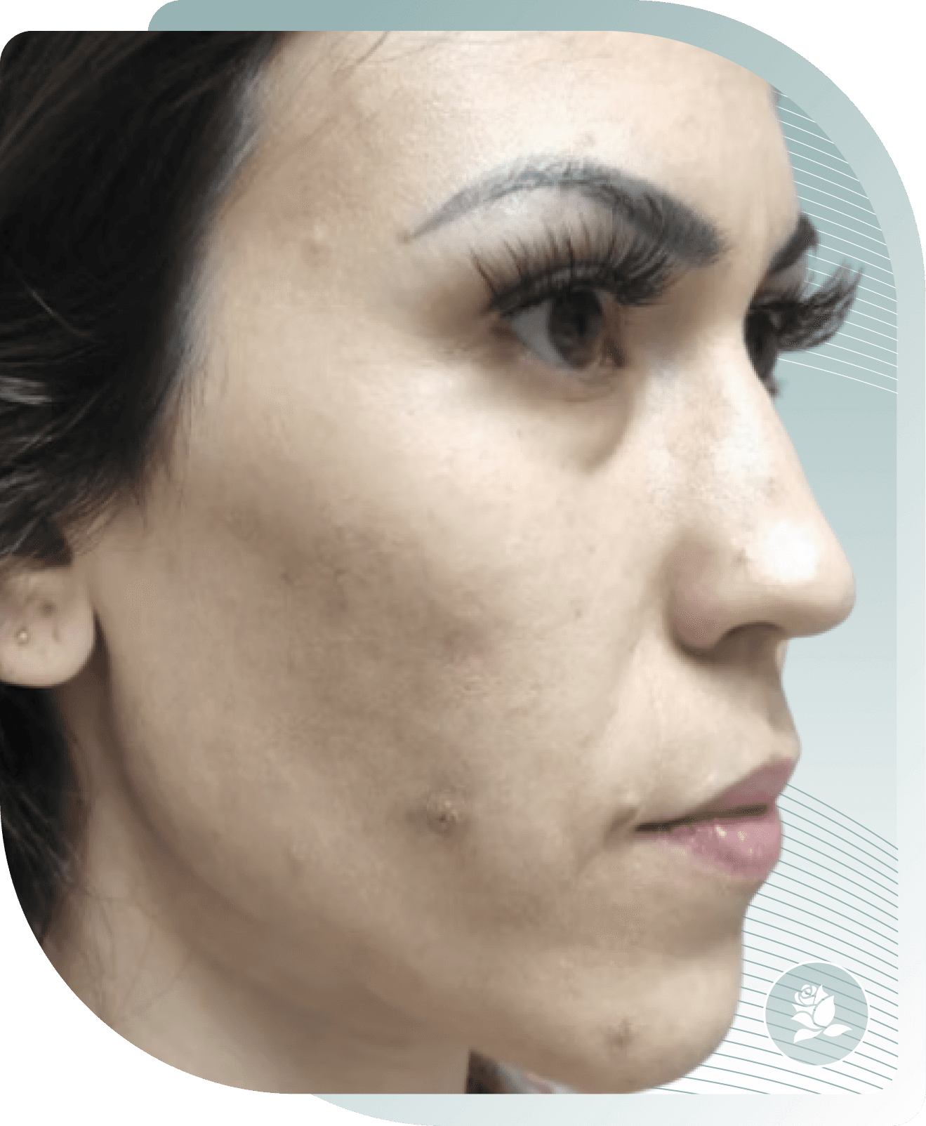 microneedling results — Before photo (result 2 of 5)