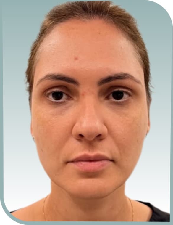 Central redness, After photo (result 3 of 10)