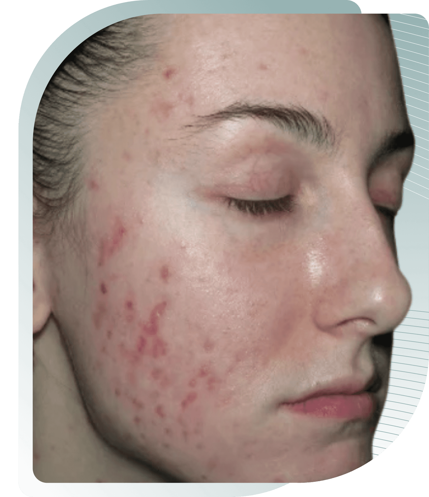 microneedling results — After photo (result 3 of 5)