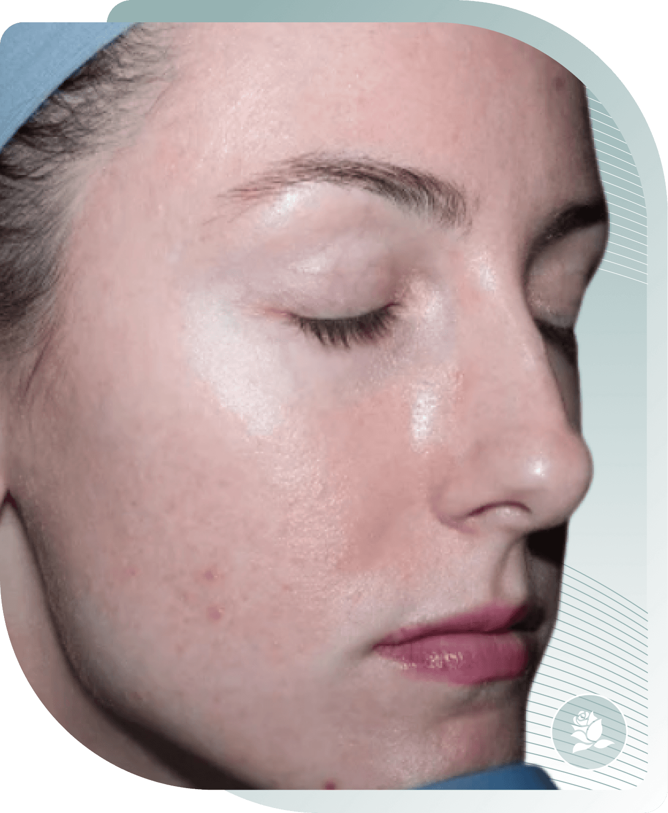 microneedling results — Before photo (result 3 of 5)
