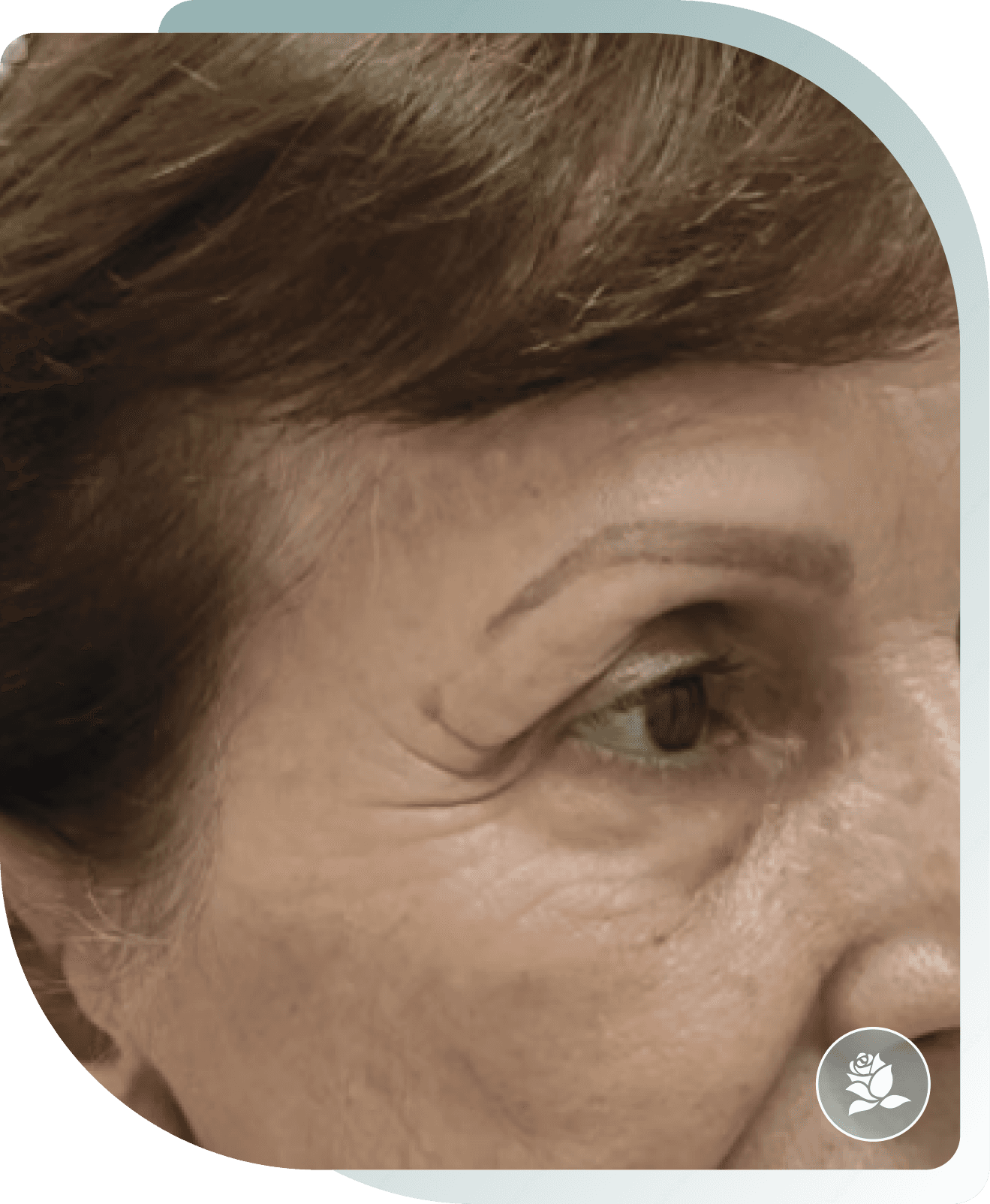 microneedling results — After photo (result 4 of 5)