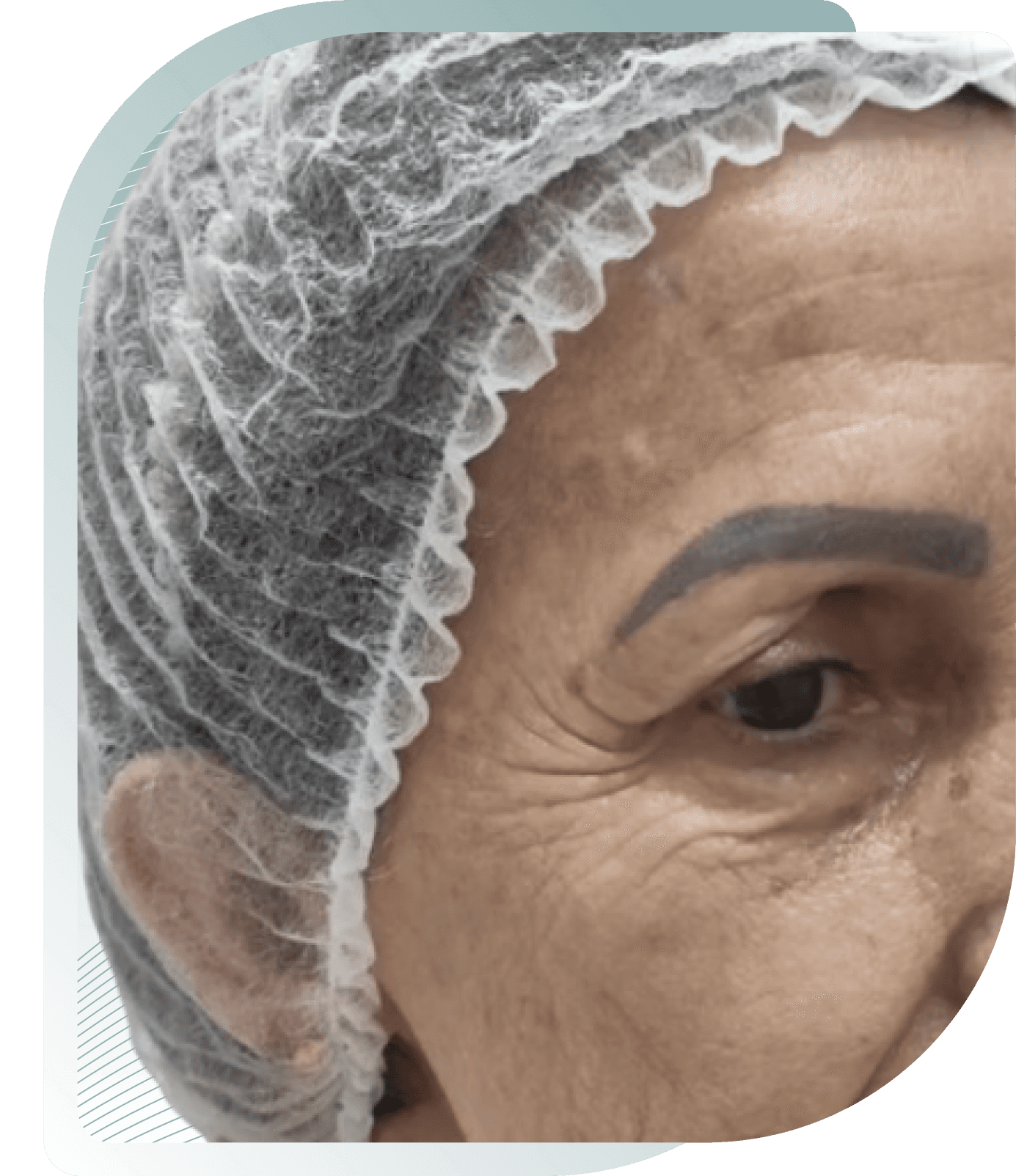 microneedling results — Before photo (result 4 of 5)