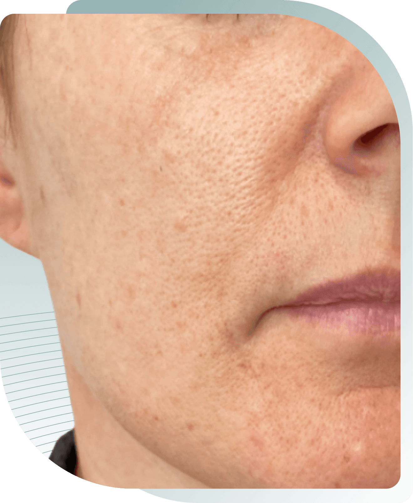 microneedling results — After photo (result 5 of 5)