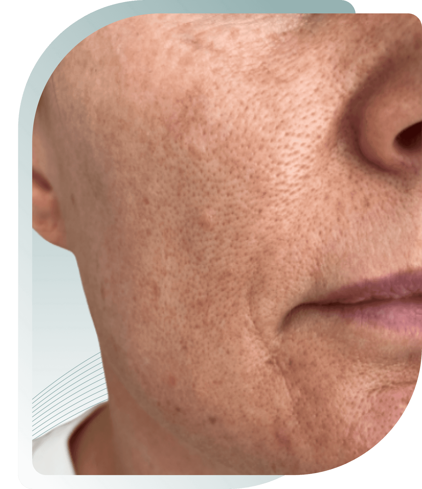 microneedling results — Before photo (result 5 of 5)