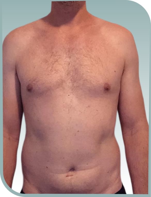 Abdominal toning, Before photo (result 1 of 10)