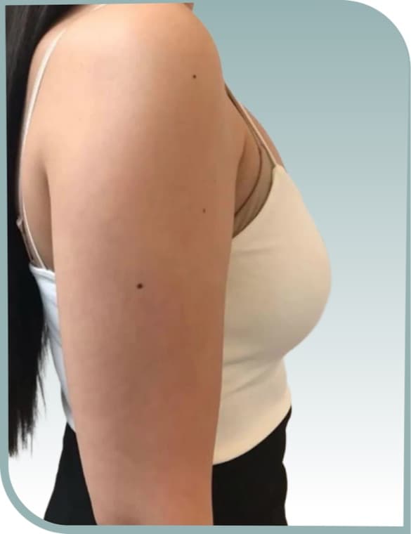 Upper arm firming, Before photo (result 2 of 10)