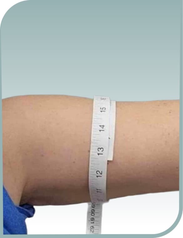Arm circumference reduction, After photo (result 9 of 10)