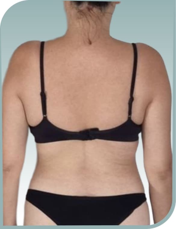 Bra line smoothing, After photo (result 10 of 10)