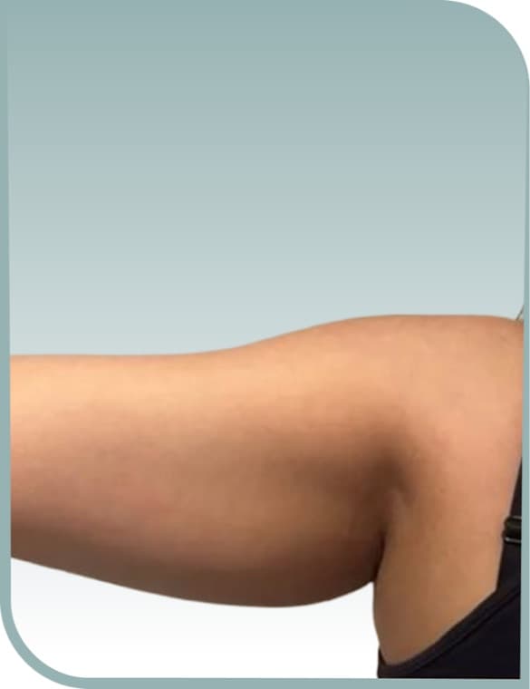 Arm definition, Before photo (result 3 of 10)
