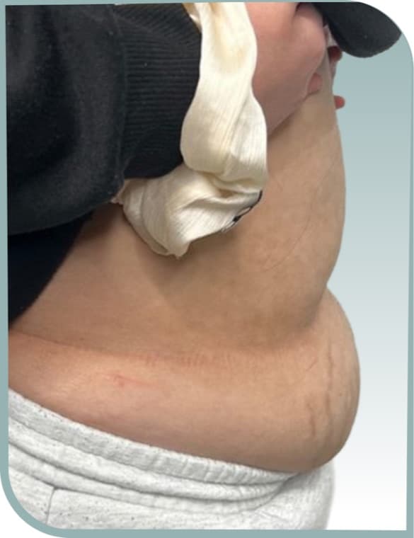 Lower belly toning, Before photo (result 4 of 10)