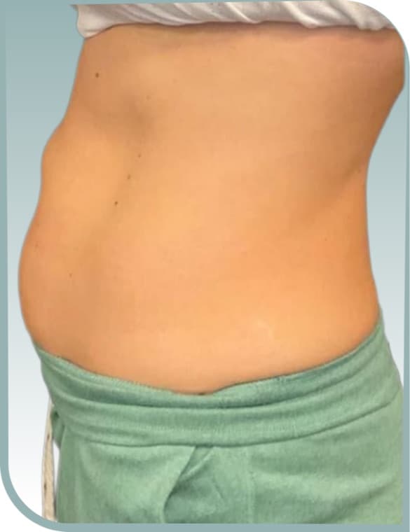 Tummy contouring, Before photo (result 5 of 10)