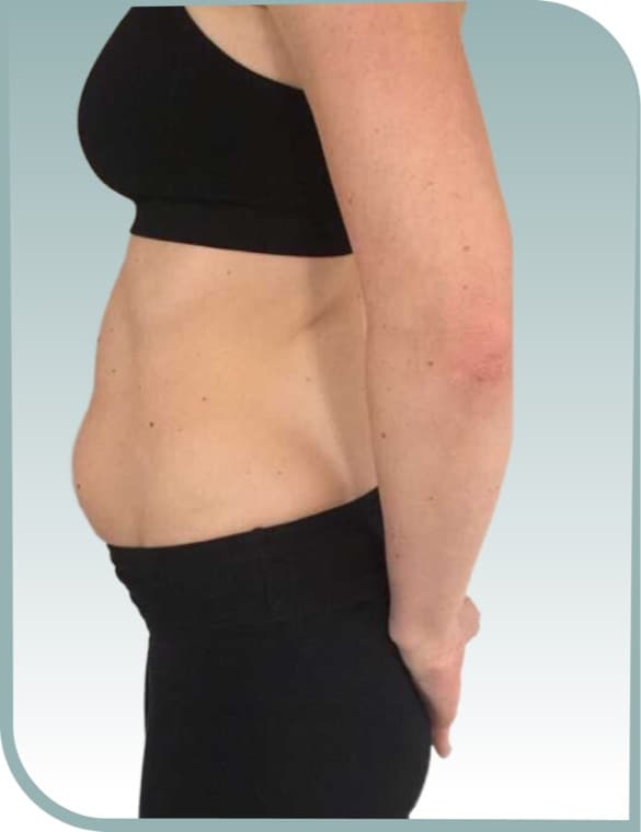 Core toning, Before photo (result 6 of 10)