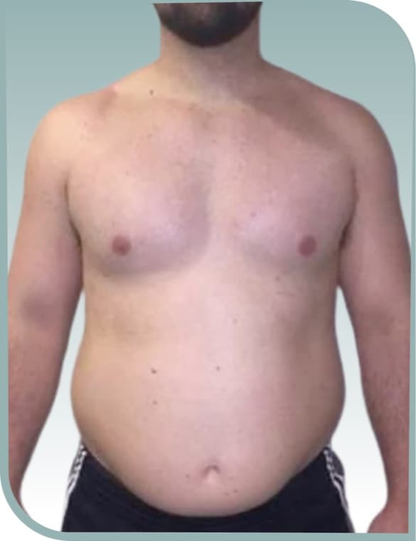 Torso sculpting, Before photo (result 7 of 10)