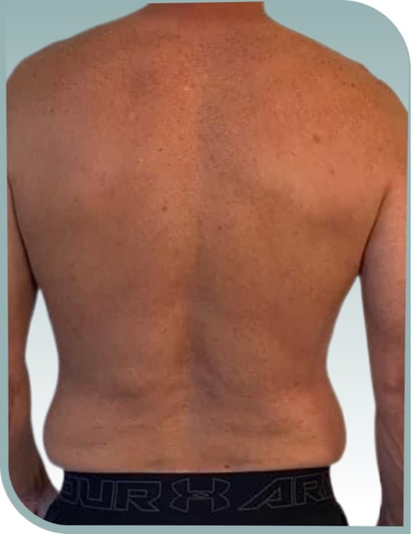 Back and flank toning, Before photo (result 8 of 10)