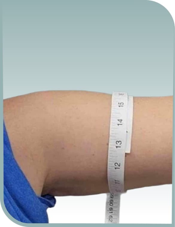 Arm circumference reduction, Before photo (result 9 of 10)