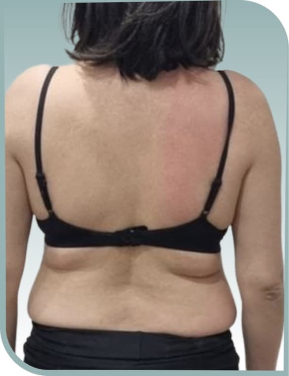 Bra line smoothing, Before photo (result 10 of 10)