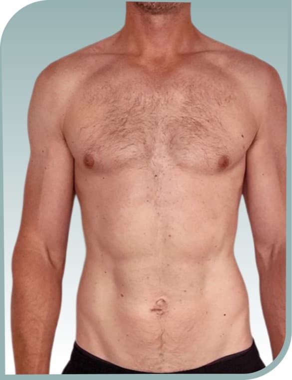 Abdominal toning, After photo (result 1 of 10)