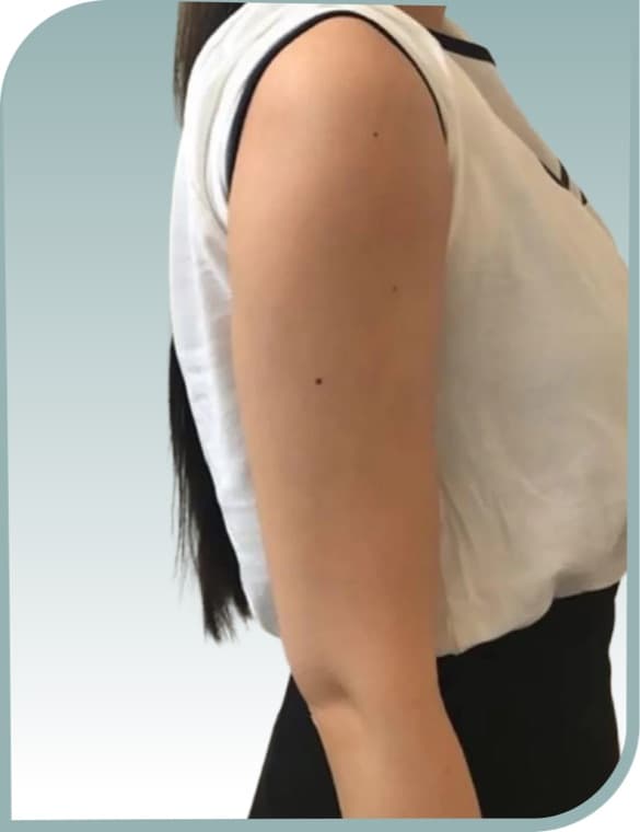 Upper arm firming, After photo (result 2 of 10)
