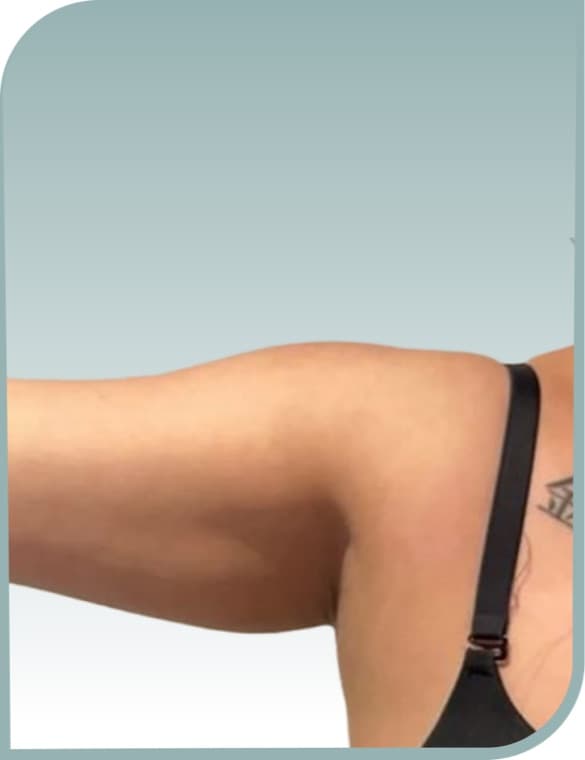 Arm definition, After photo (result 3 of 10)