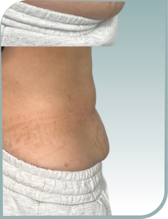 Lower belly toning, After photo (result 4 of 10)