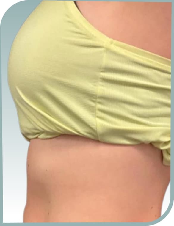 Tummy contouring, After photo (result 5 of 10)