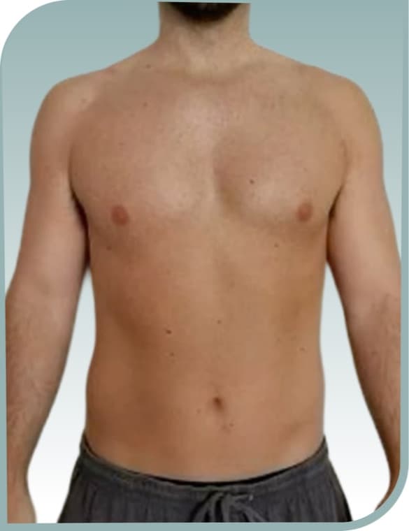 Torso sculpting, After photo (result 7 of 10)