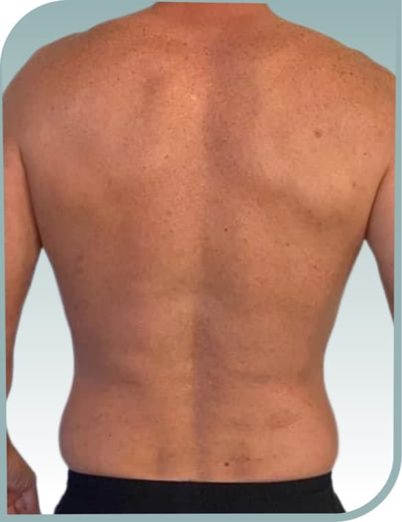 Back and flank toning, After photo (result 8 of 10)