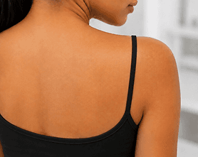 PICO LASER TATTOO REMOVAL RESULTS — After photo (result 1 of 1)