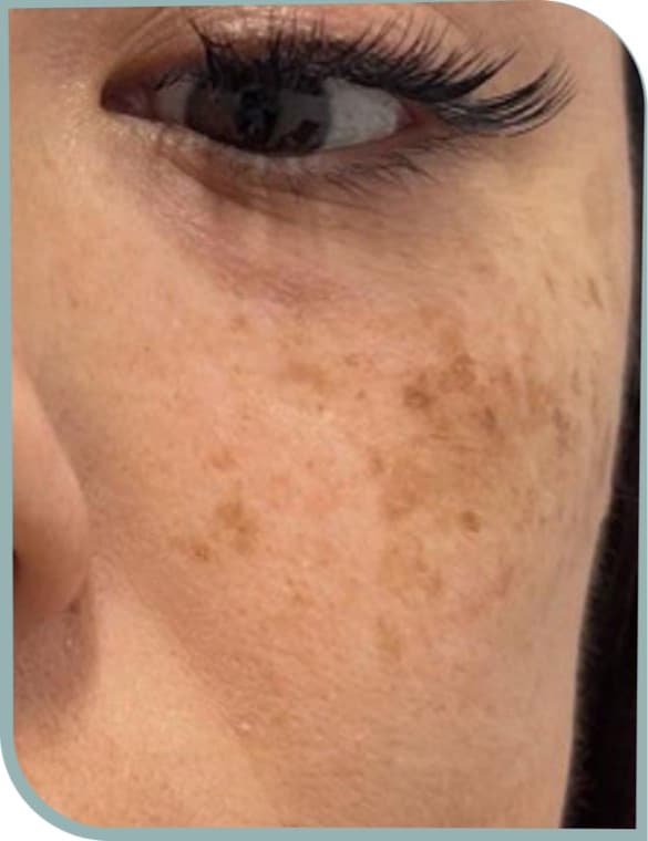 Cheek sun spots, Before photo (result 1 of 10)