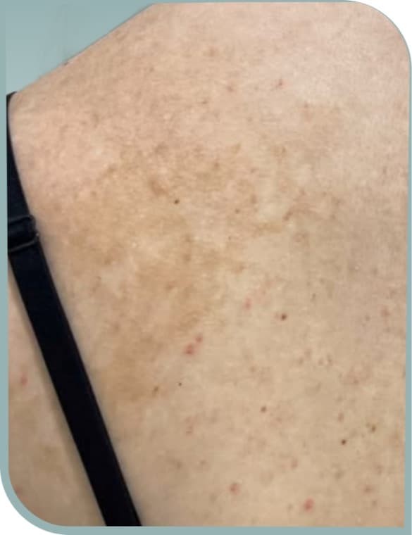 Upper back sun damage, Before photo (result 2 of 10)