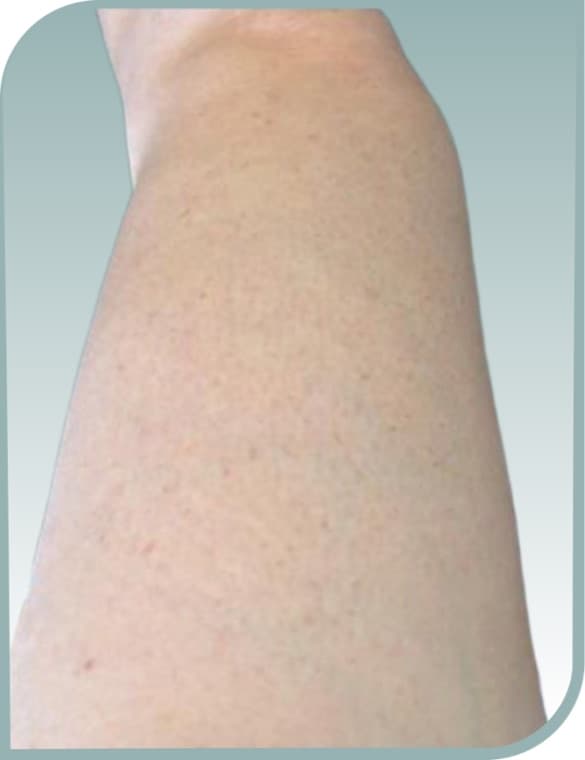 Thigh dark spots, After photo (result 9 of 10)