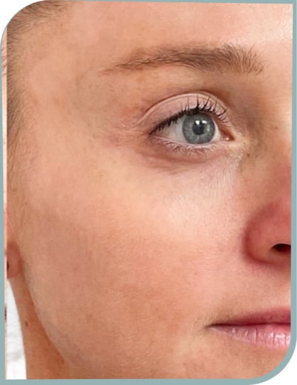 Cheek freckling, After photo (result 10 of 10)