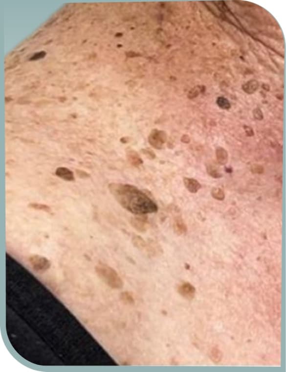 Neck dark spots, Before photo (result 3 of 10)
