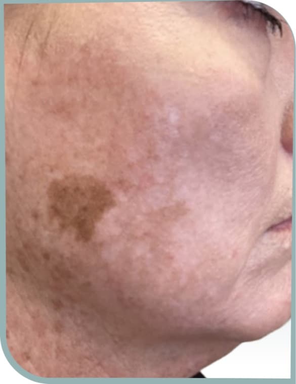 Cheek melasma patch, Before photo (result 4 of 10)