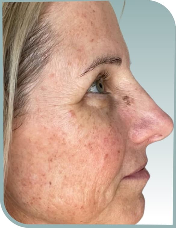 Facial freckling, Before photo (result 5 of 10)