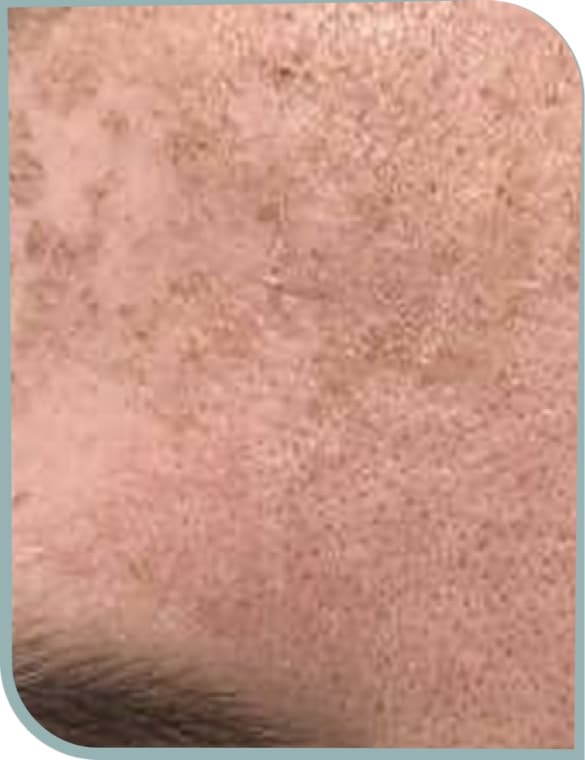 Forehead pigmentation, Before photo (result 6 of 10)
