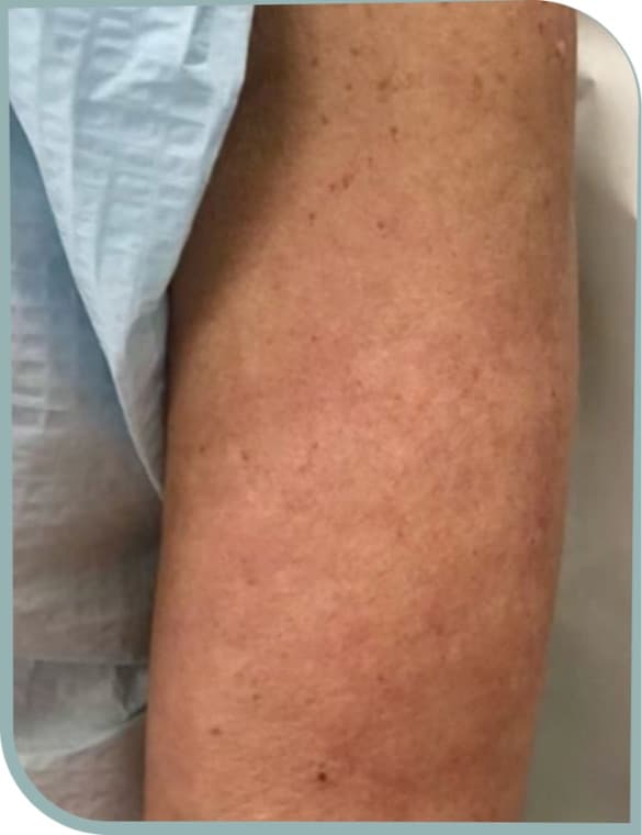 Upper arm sun spots, Before photo (result 7 of 10)